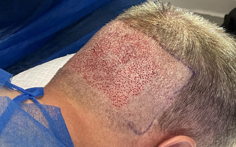 Why FUE Is a Popular Hair Restoration Treatment