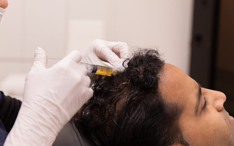 Combining PRP with Hair Transplant for Better Results