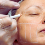 How HIFU Helps in Anti-Aging and Skin Lifting
