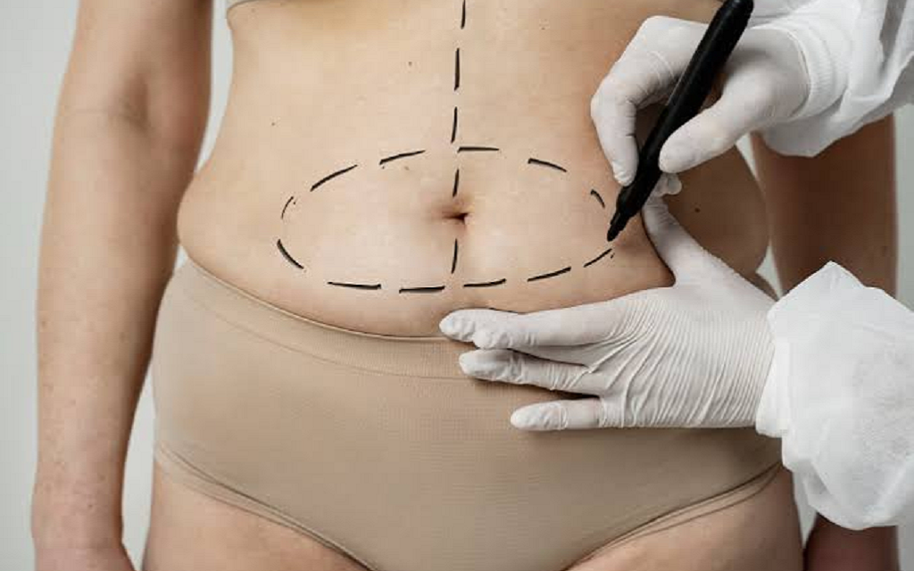 Liposuction in Islamabad - Fat Removal Surgery