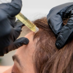 PRP Therapy A Natural Hair Growth Treatment