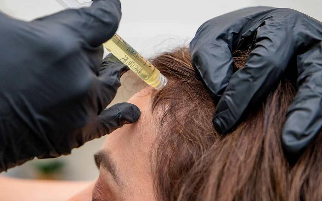 PRP Therapy A Natural Hair Growth Treatment