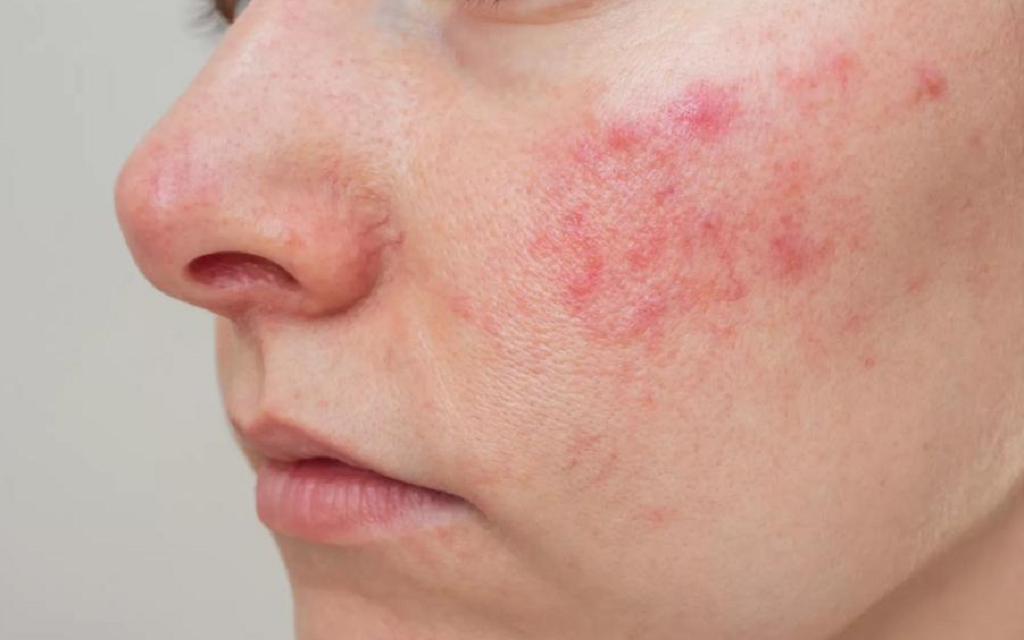 Rosacea Treatment in Islamabad - Estheticare Group Clinic