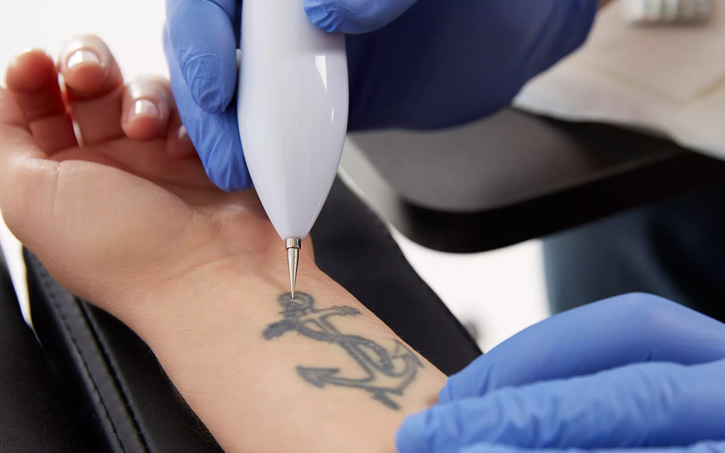 laser tattoo removal in islamabad