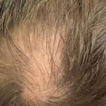 Can Exosome Therapy Help with Thinning Hair or Bald Spots