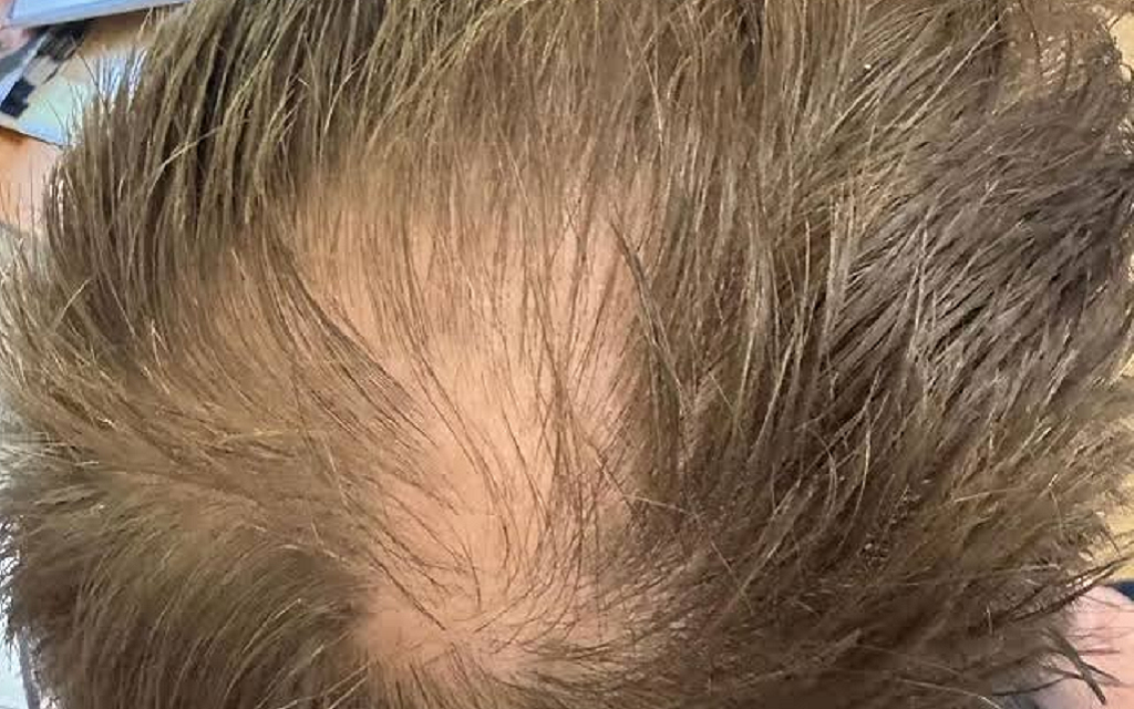 Can Exosome Therapy Help with Thinning Hair or Bald Spots?