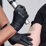 Does Tattoo Removal Hurt