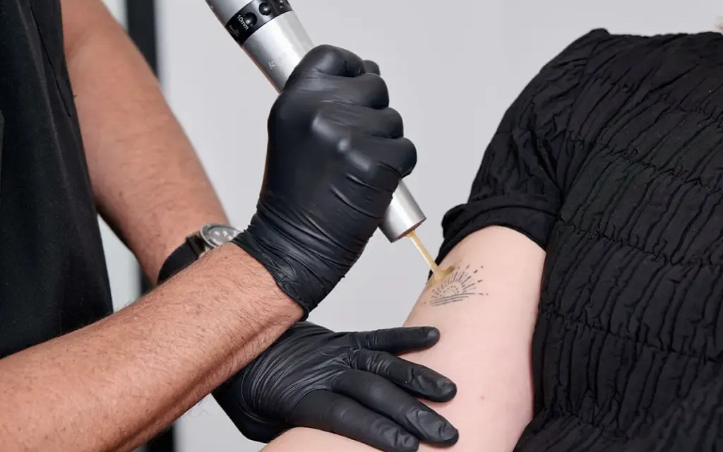 Does Tattoo Removal Hurt