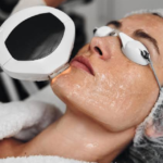 How Is Sculptra Different From Other Facial Fillers