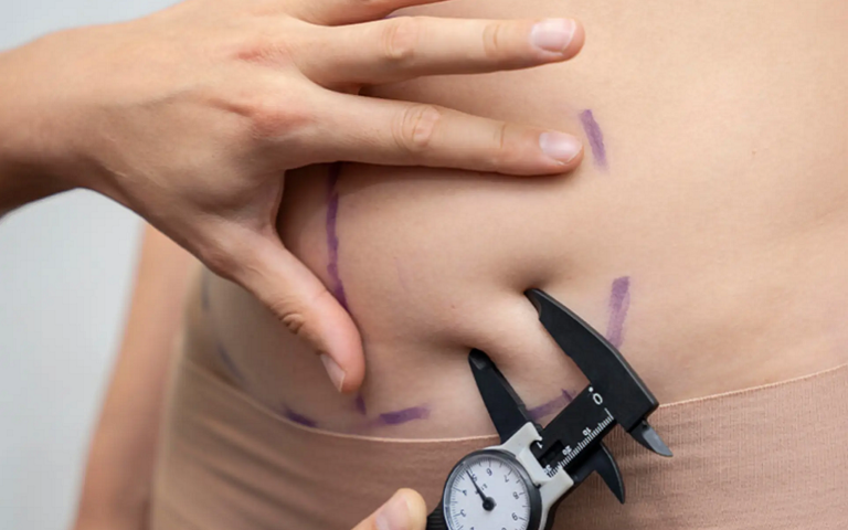 How Long Does It Take To Recover From Liposuction