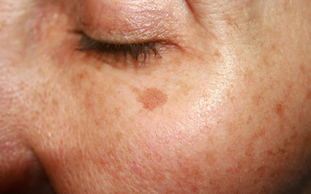 Hyperpigmentation Treatment in Islamabad - Estheticare Group
