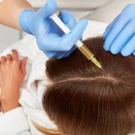 Benefits of PRP for Hair Restoration