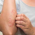 Can Skin Whitening Cause Allergies