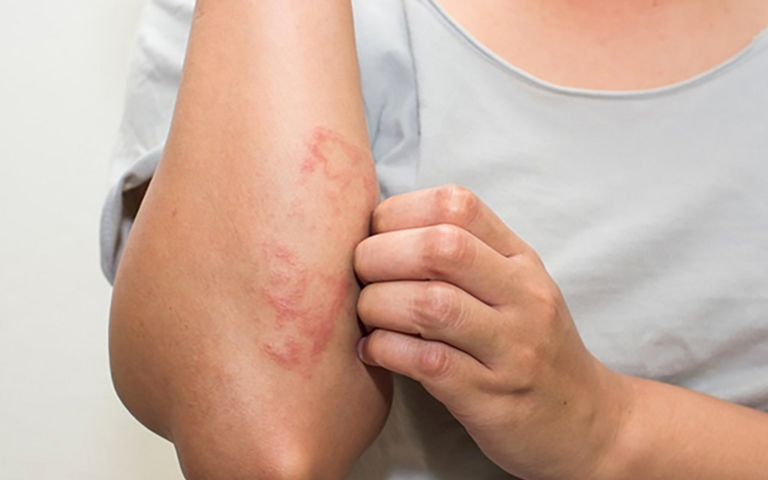 Can Skin Whitening Cause Allergies