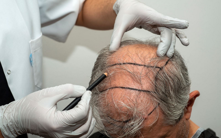FUT Hair Transplant How It Works