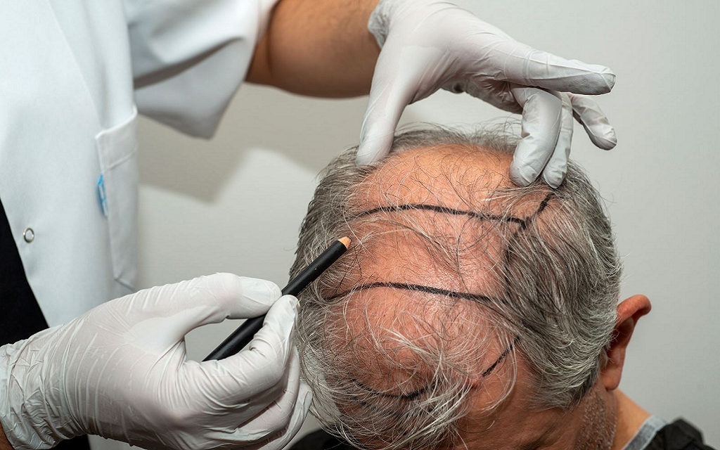 FUT Hair Transplant How It Works