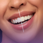 Professional vs DIY Teeth Whitening Which Is Better