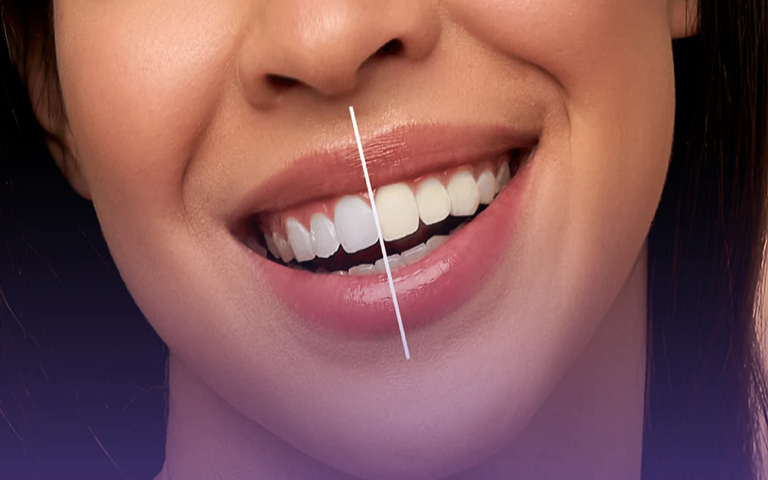 Professional vs DIY Teeth Whitening Which Is Better