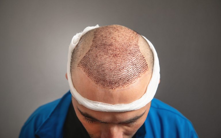 FUE Hair Transplant Procedure, Benefits, and Results