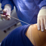 How Long Does It Take To Recover From Liposuction