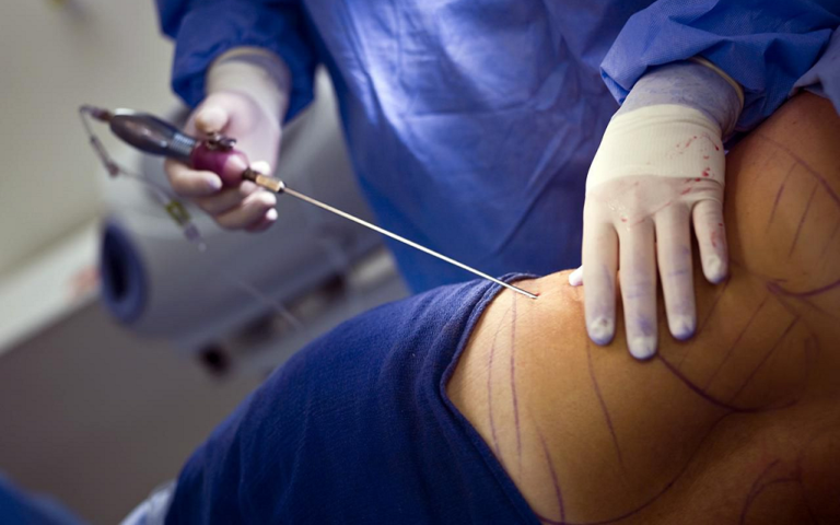 How Long Does It Take To Recover From Liposuction