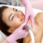 Laser Whitening vs. Peels What’s More Effective