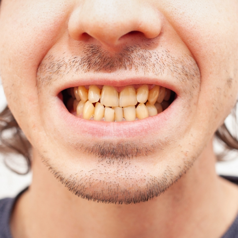 Can Teeth Whitening Help with Yellow Teeth