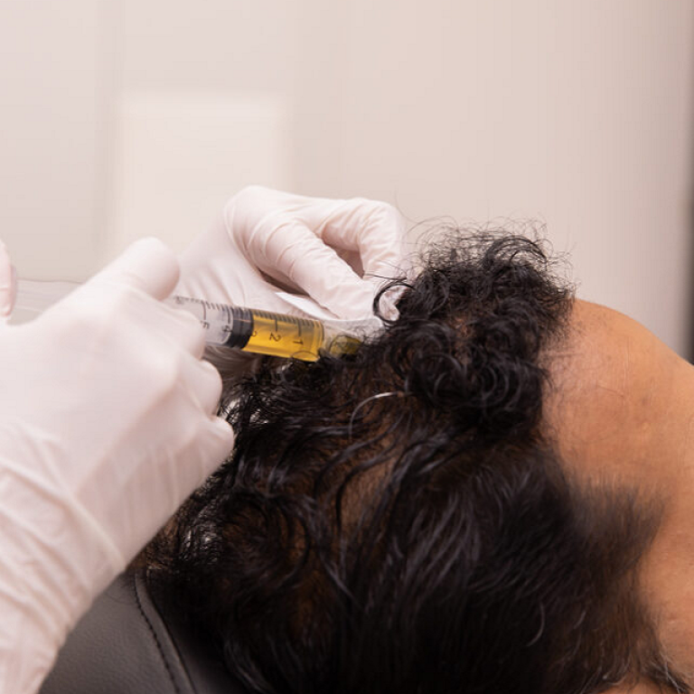 Combining PRP with Hair Transplant for Better Results
