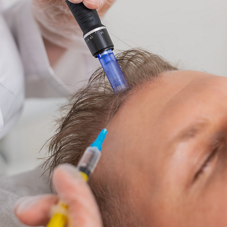 Exosome Therapy for Skin & Hair Regeneration