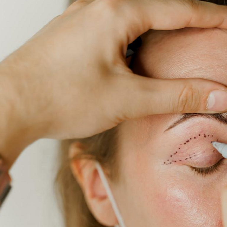 Eyelid Surgery (Blepharoplasty) in Islamabad
