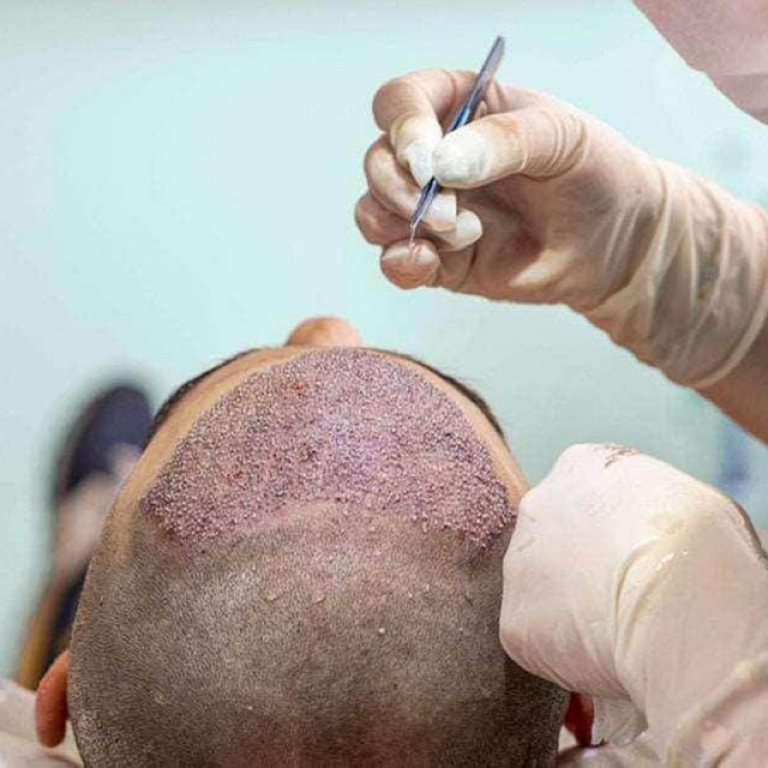 FUE Hair Transplant in Islamabad