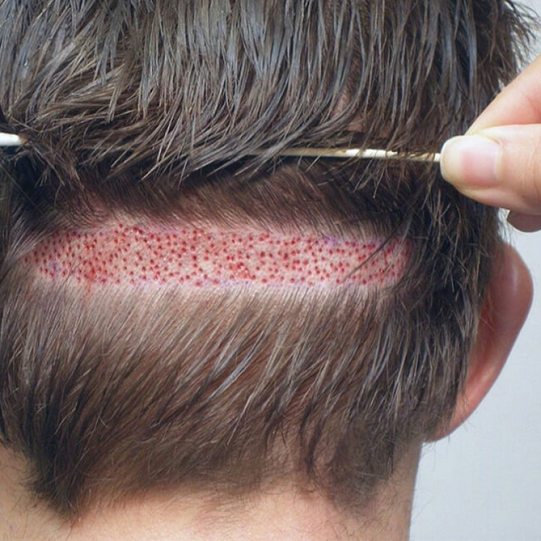 FUT Hair Transplant in Islamabad