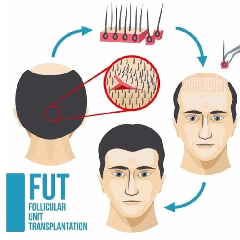 FUT Hair transplant in islamabad