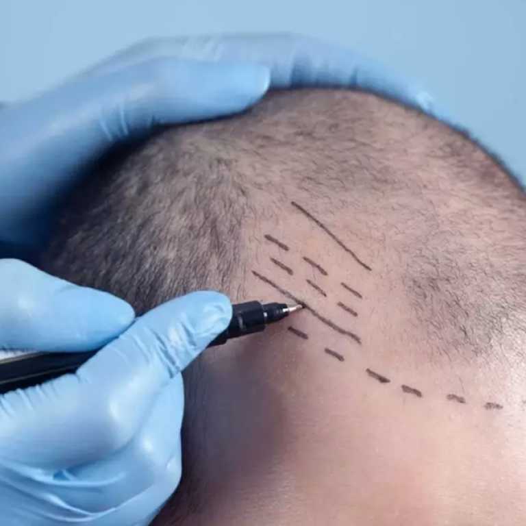 Fue Hair transplant in Islamabad