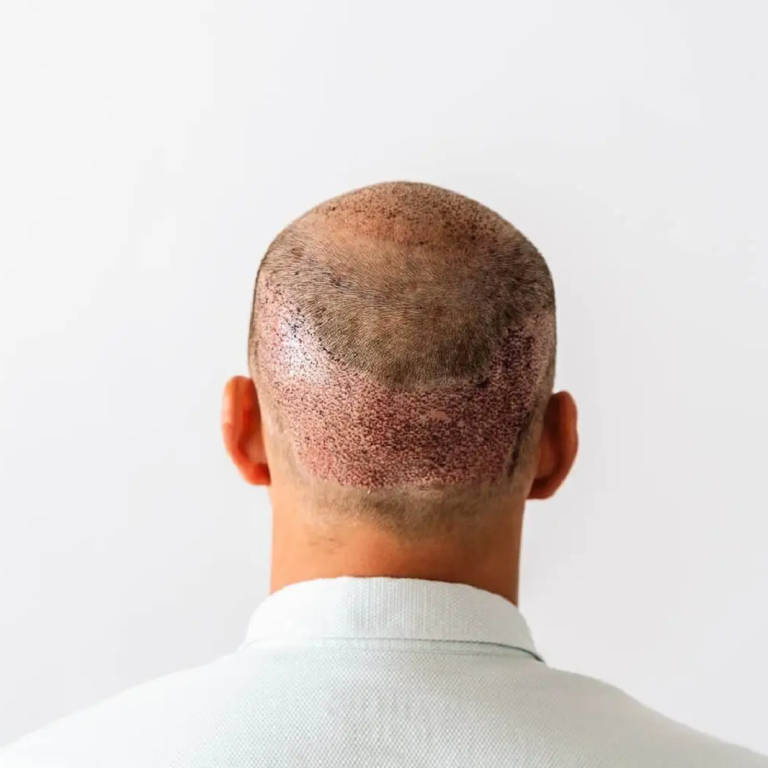 Hair Transplant in Islamabad Pakistan Estheticare Clinic