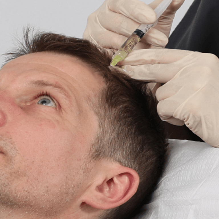 How Many PRP Sessions Are Needed for Hair Growth