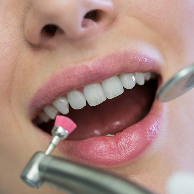 How Much Does Teeth Whitening Cost