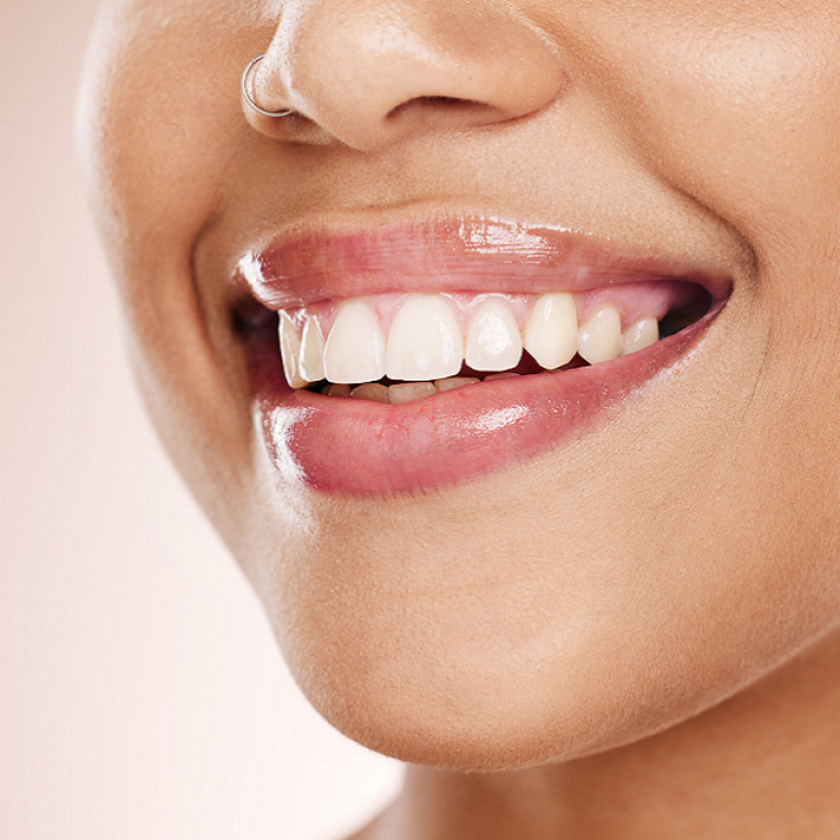 How Often Should You Whiten Your Teeth