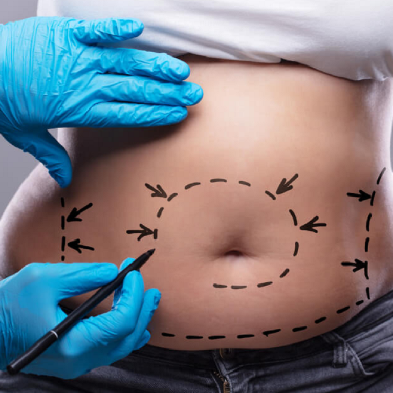 Is Liposuction a Safe Procedure