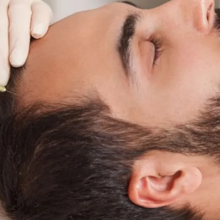 Reasonable PRP Treatment for Men in Islamabad
