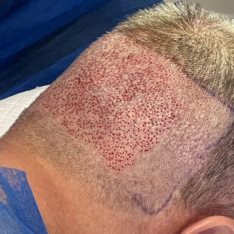 Why FUE Is a Popular Hair Restoration Treatment