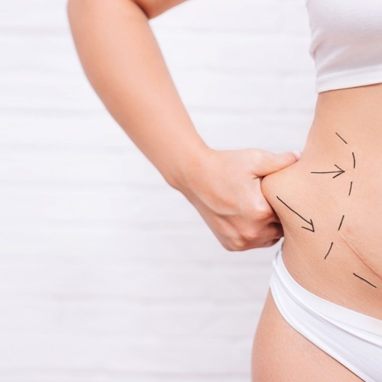 liposuction in Islamabad